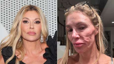 Exestrella de ‘Real Housewives’ cuenta su lucha contra una rara enfermedad facial